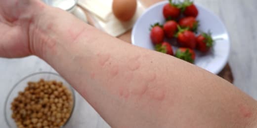 Food Allergens - Featured Image
