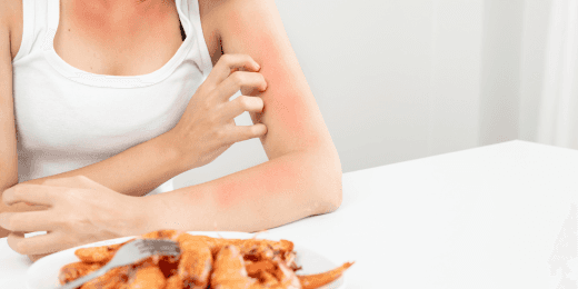 A woman covered in rashes after having an allergic reaction to shrimp.
